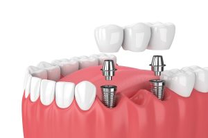 A Little Bit About Tooth Implants